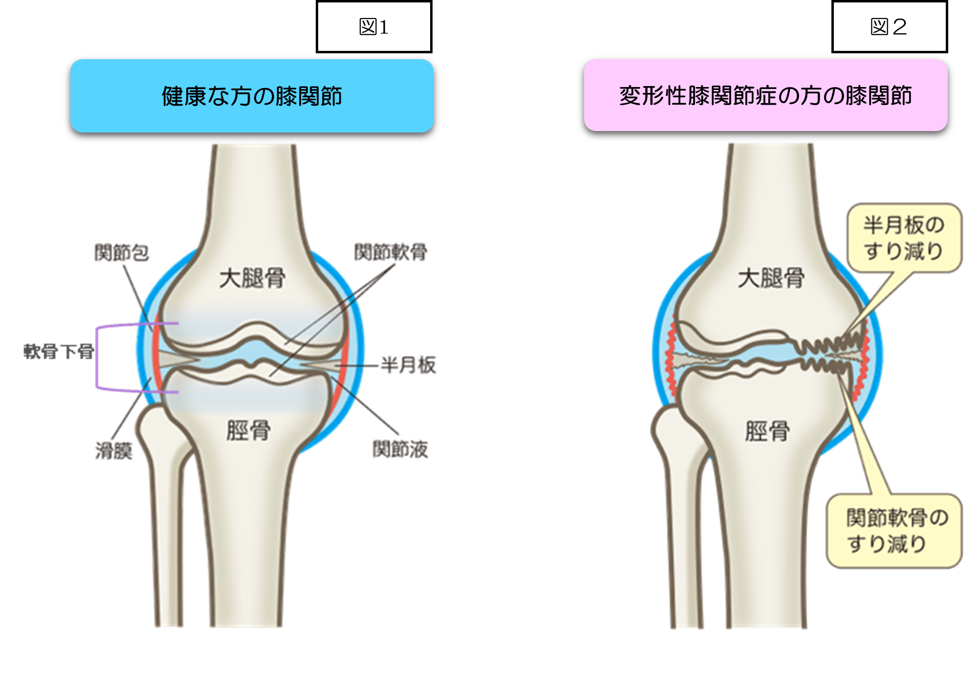 軟骨無形成症の真実｜原因・遺伝から最新薬ボソモチドの現場まで解説