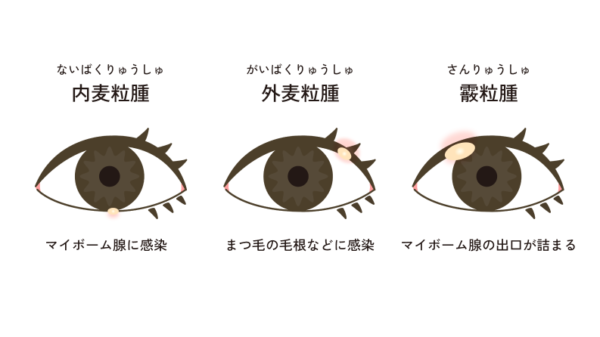 ものもらいとは？うつる噂の真相や麦粒腫・霰粒腫の違いと治し方