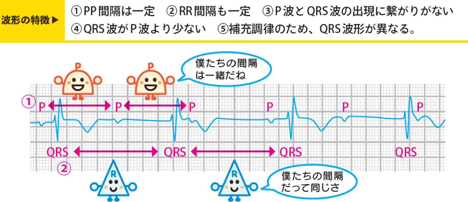 突然の失神は完全房室ブロック？心電図・原因とペースメーカー適応