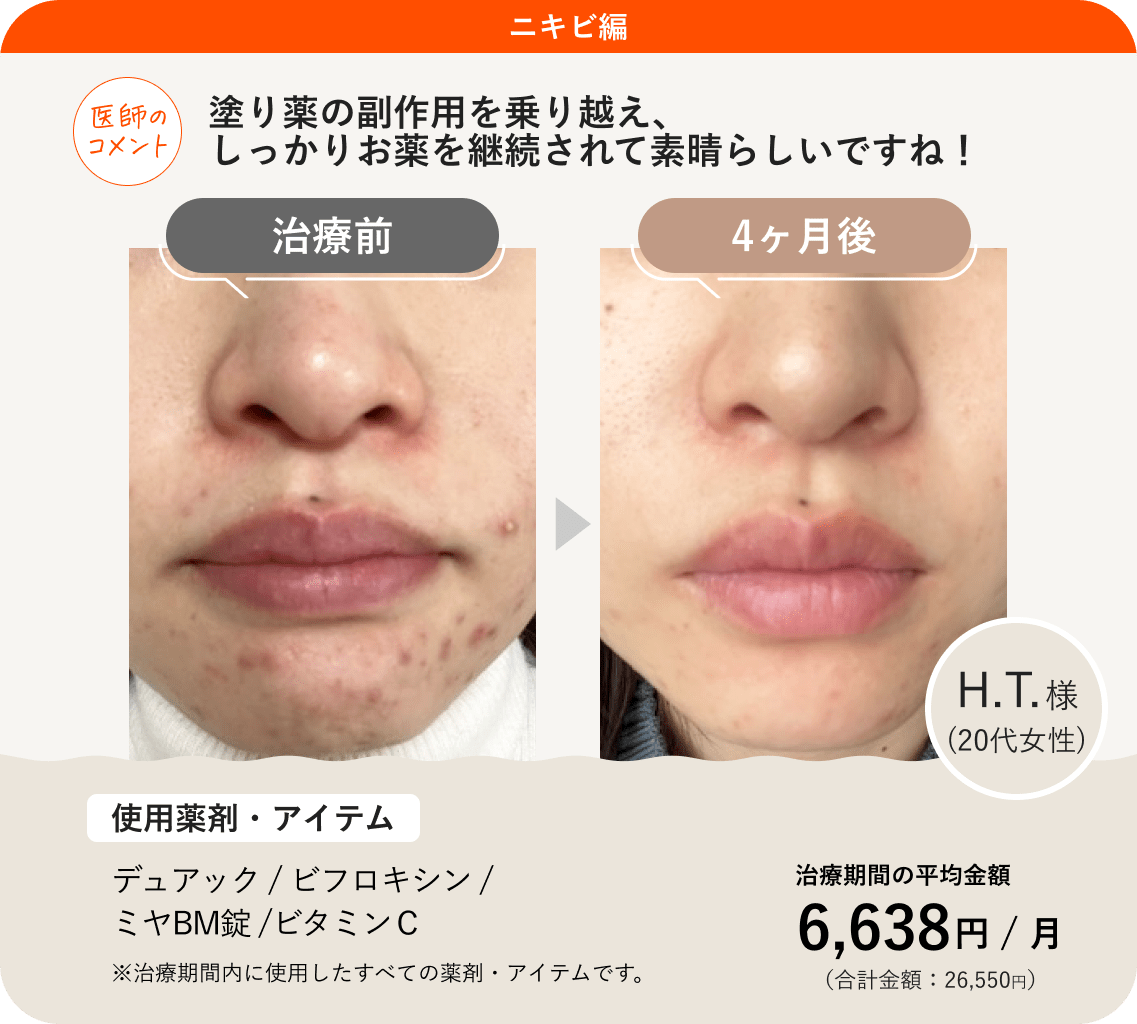 毎月繰り返す生理前ニキビの真相｜ホルモンの正体と正しい治し方