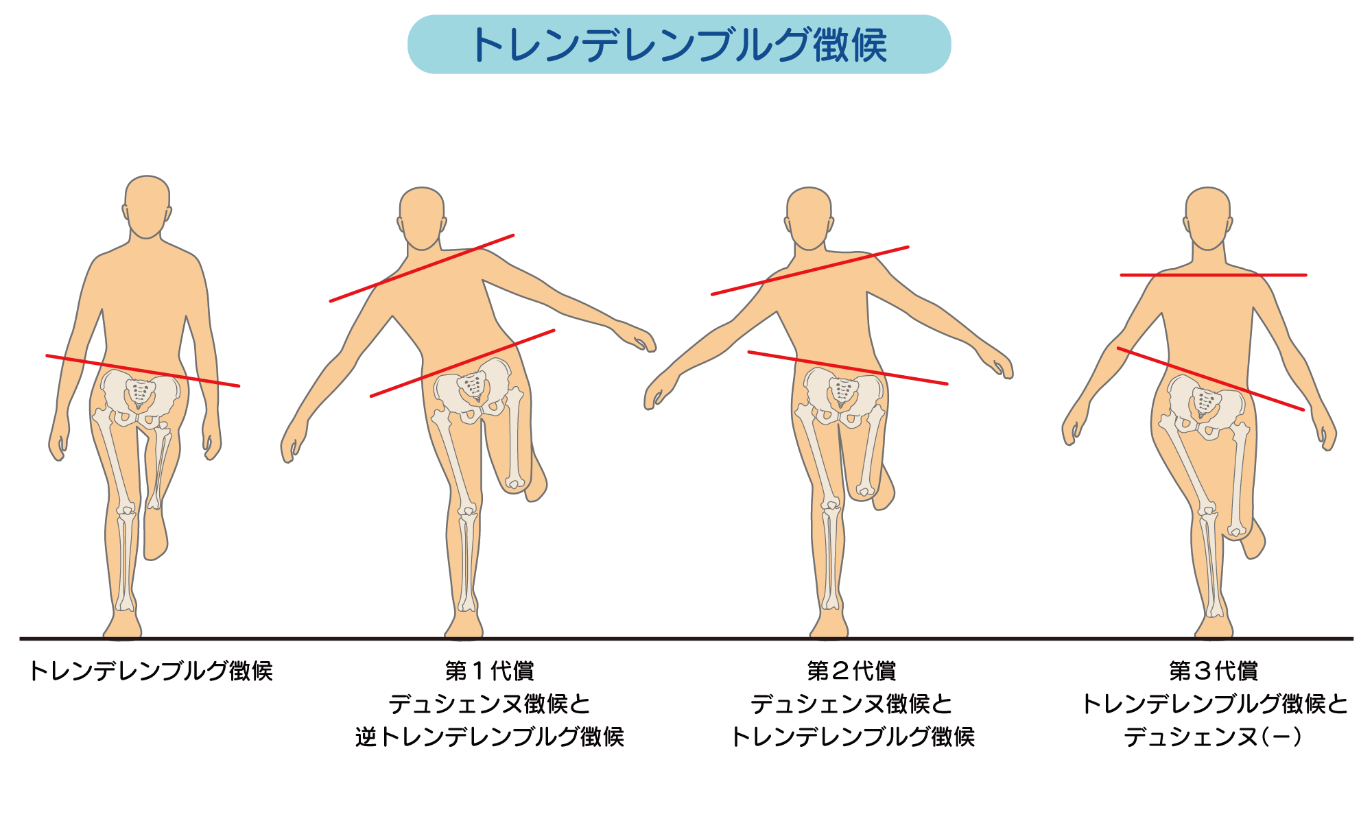 なぜ骨盤が下がるのか？トレンドレンブルグ歩行の真相と最新リハビリ法