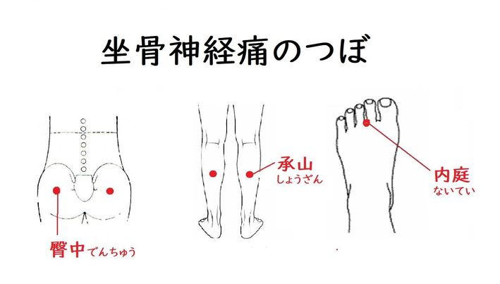 坐骨神経痛に効くツボ決定版！お尻・足のしびれを緩和する押し方とNg習慣