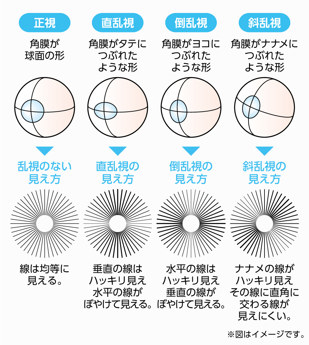 乱視の見え方とは？二重ボケや夜の光のにじみの原因と最新矯正法