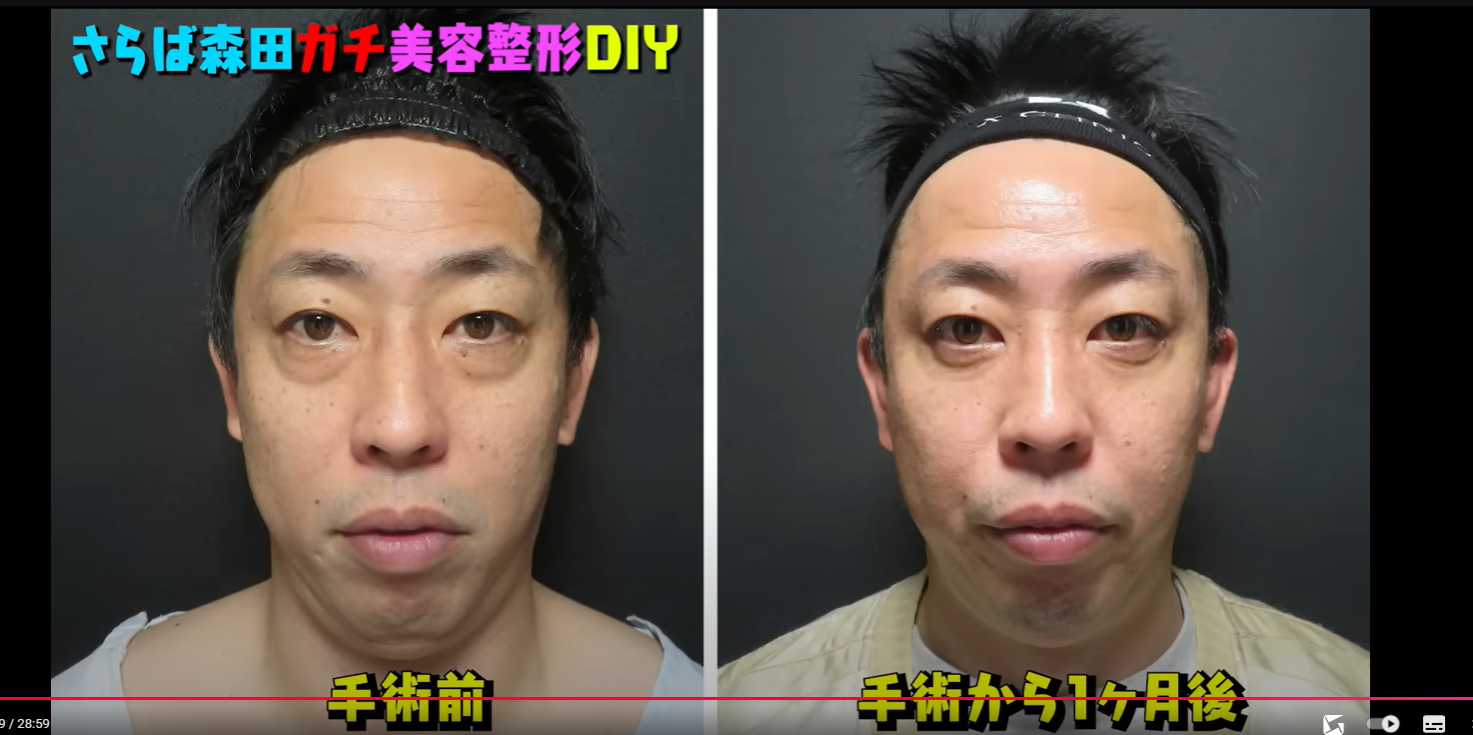 目の下の黒い影は役作りか疲労か？実態スクープと極秘の解消法