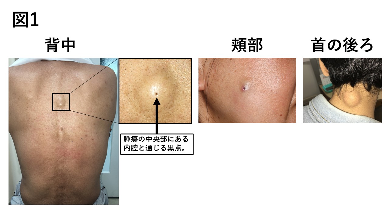 粉瘤の特徴とは？ニキビとの違いや黒い点の正体・2026最新治療法