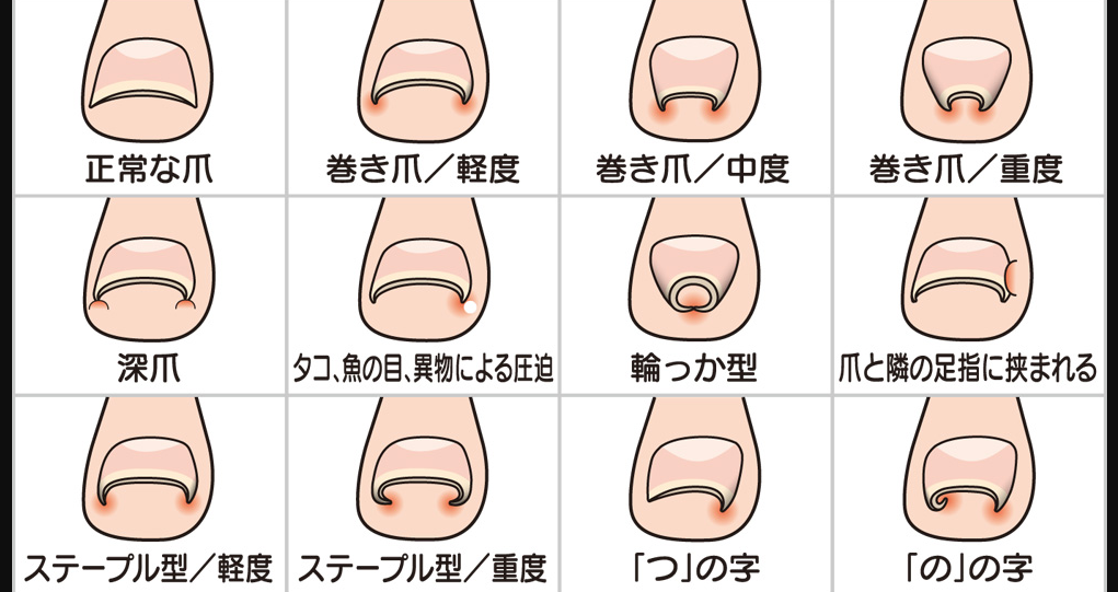 【経歴】 爪 に 現れる 病気 の サイン 最新画像・動画まとめ #937