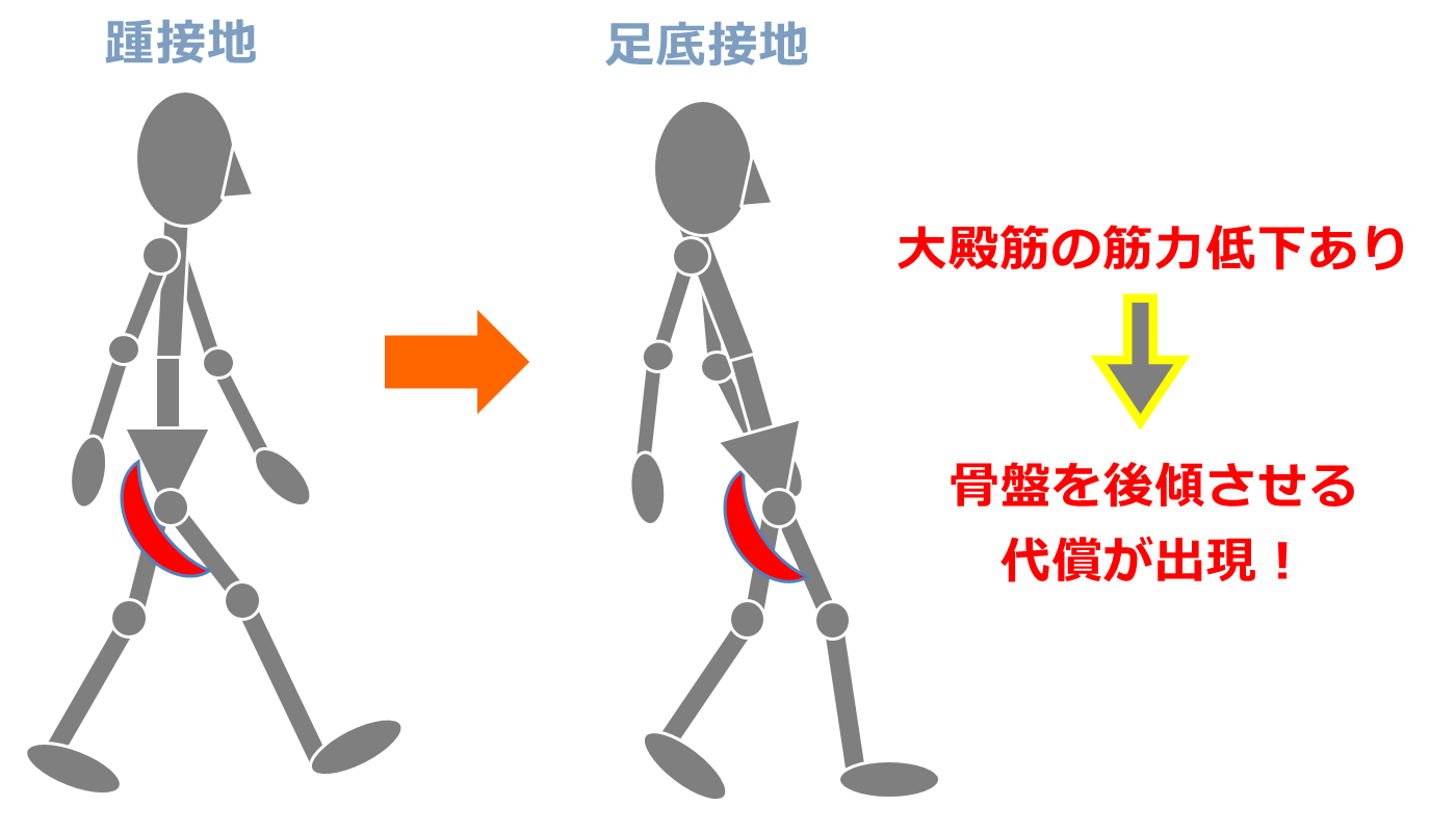大臀筋歩行はなぜ起こる？体幹後方傾斜の理由と2026年最新リハビリ法