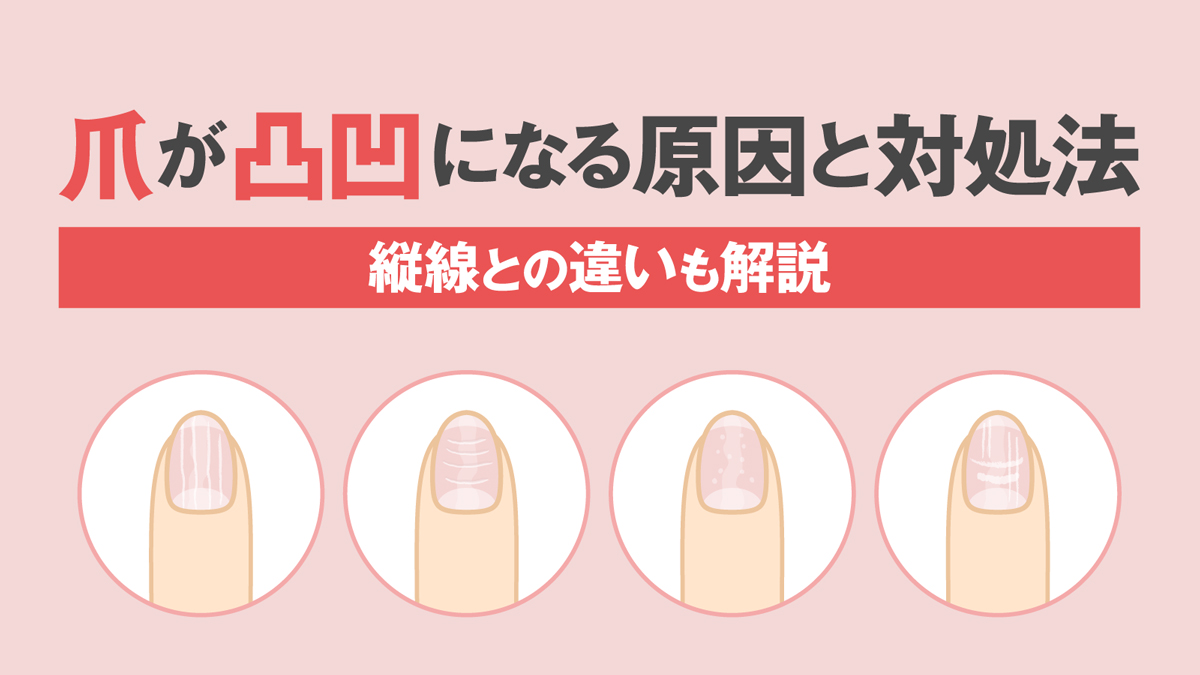 爪が凹んでる原因と病気サイン｜横線・スプーン爪の危険度と治し方