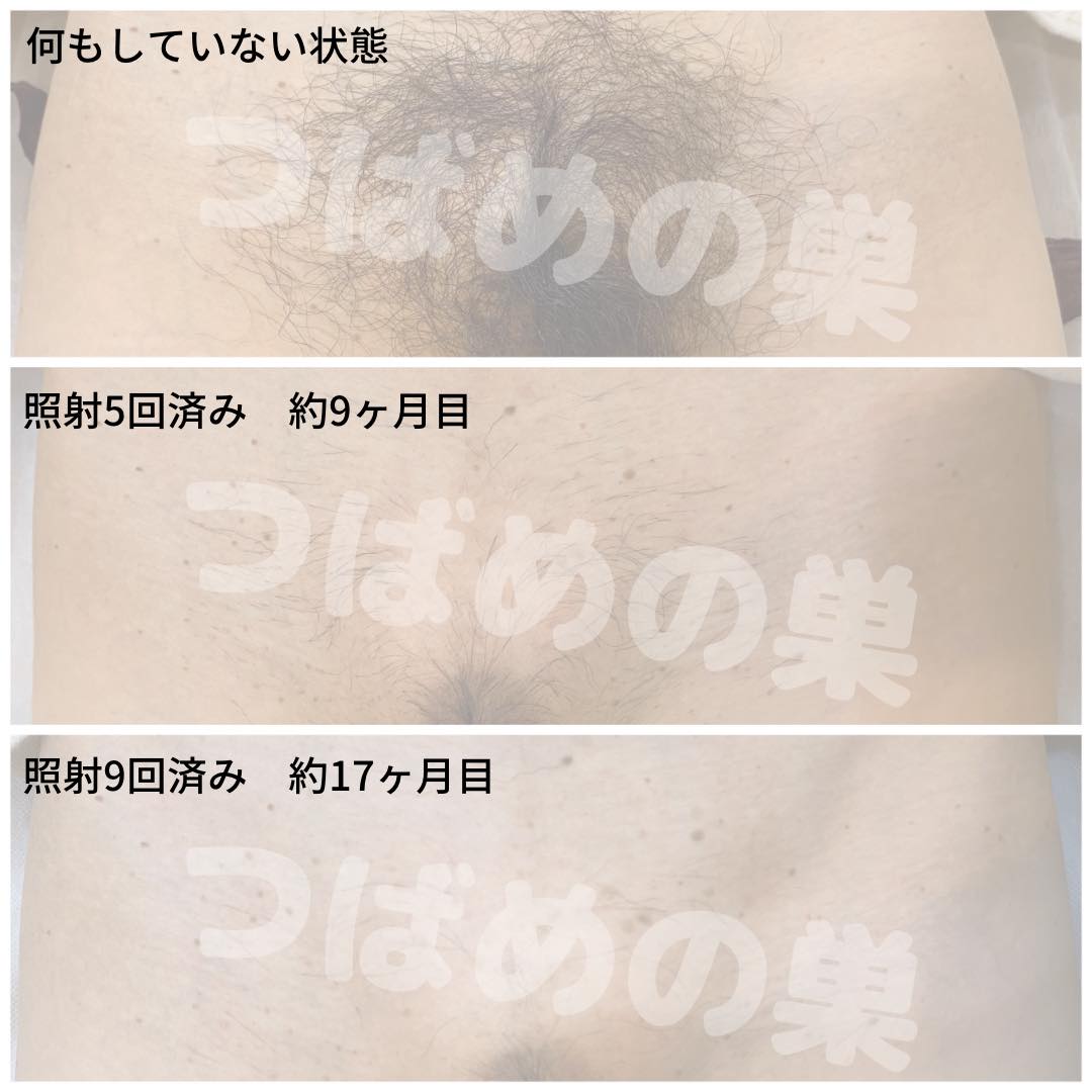 女性のVio脱毛写真を徹底検証！効果や痛みと後悔しない2026年最新基準