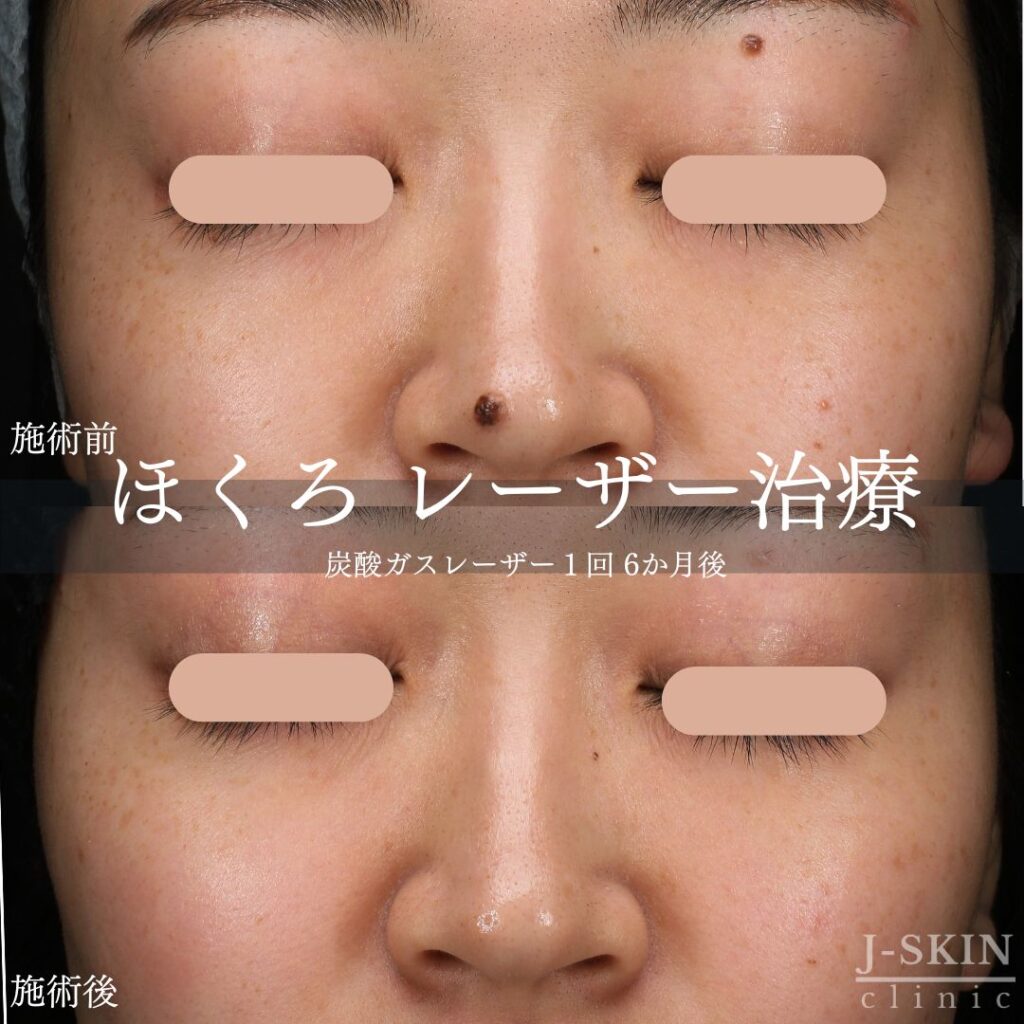 鼻のほくろが示す意味とは？人相学の真相と病気リスク・除去法まで徹底解説