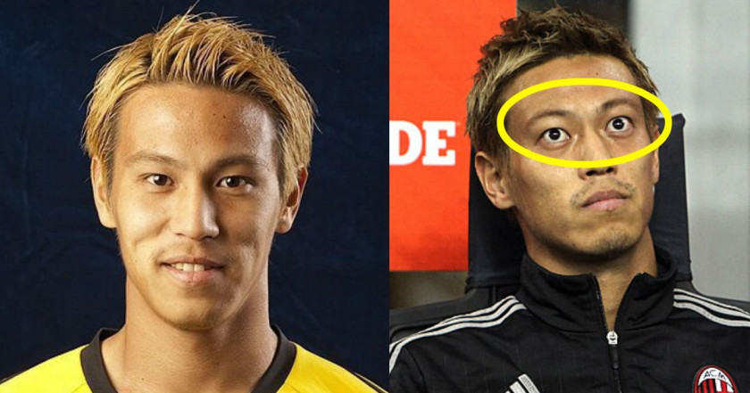 本田圭佑の首の手術跡と噂の真相！バセドウ病説と現在の体調を追う
