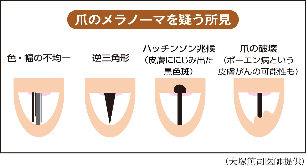 爪の黒い縦線は放置危険？メラノーマの見分け方と受診基準【2026年最新】