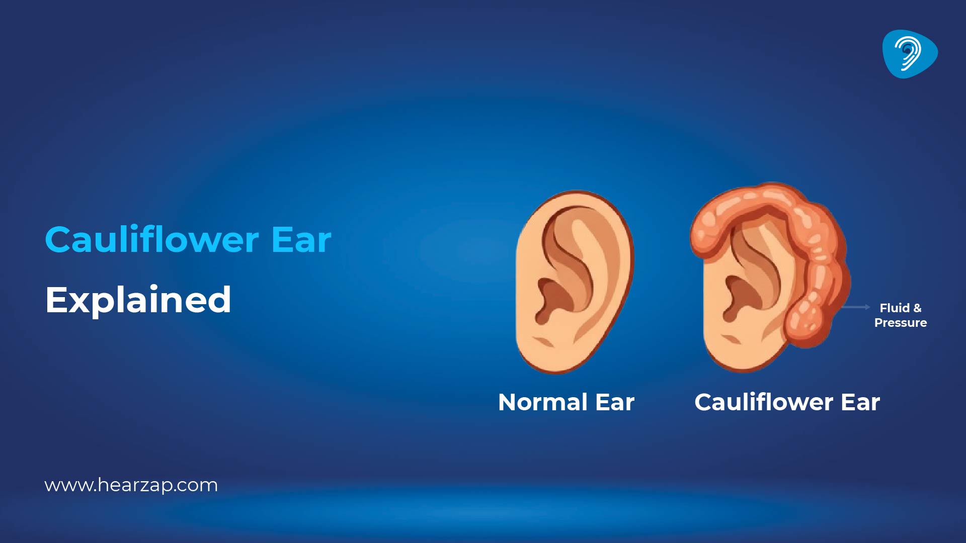 Will Cauliflower Ear Go Away