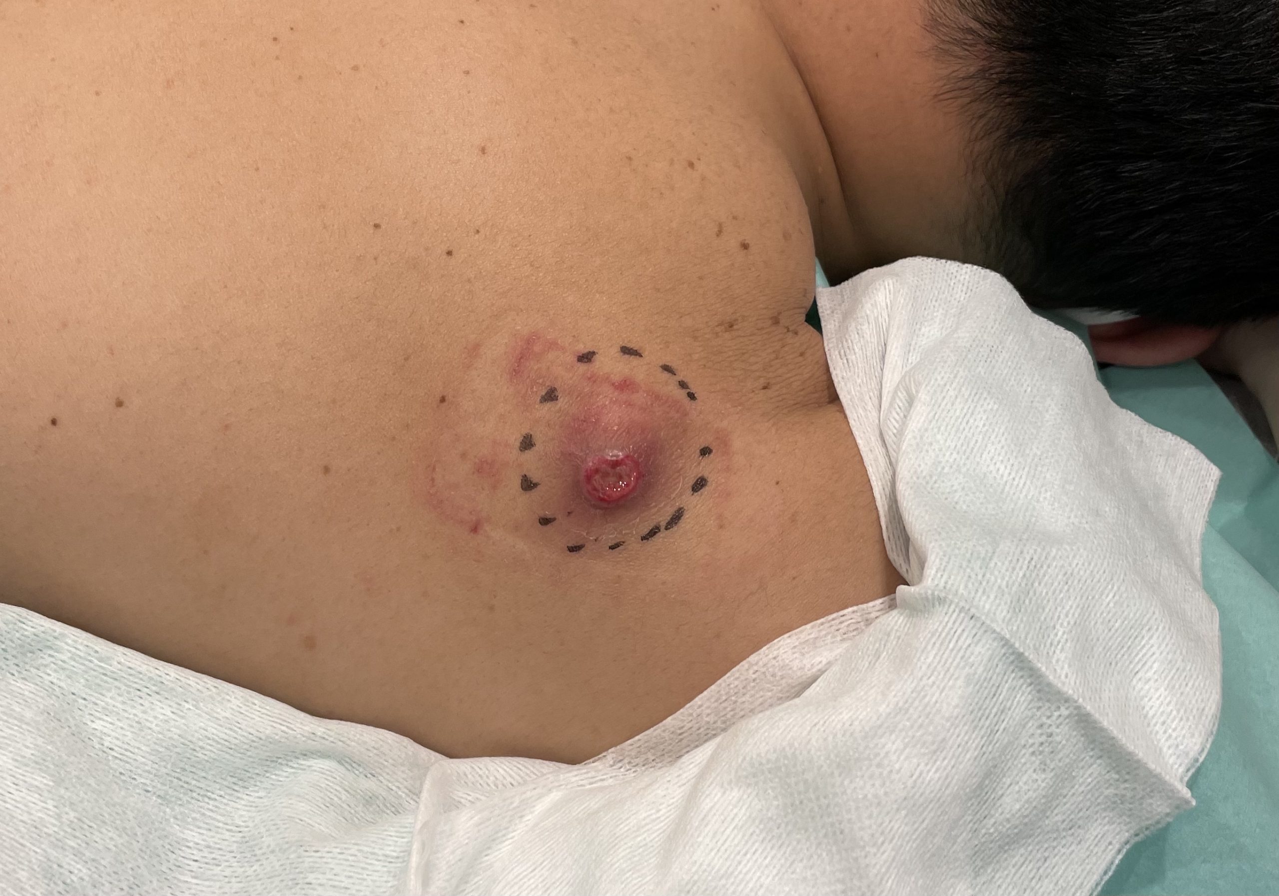 粉瘤の袋を自分で取るのは絶対Ng？潰す危険性と正しい完治法