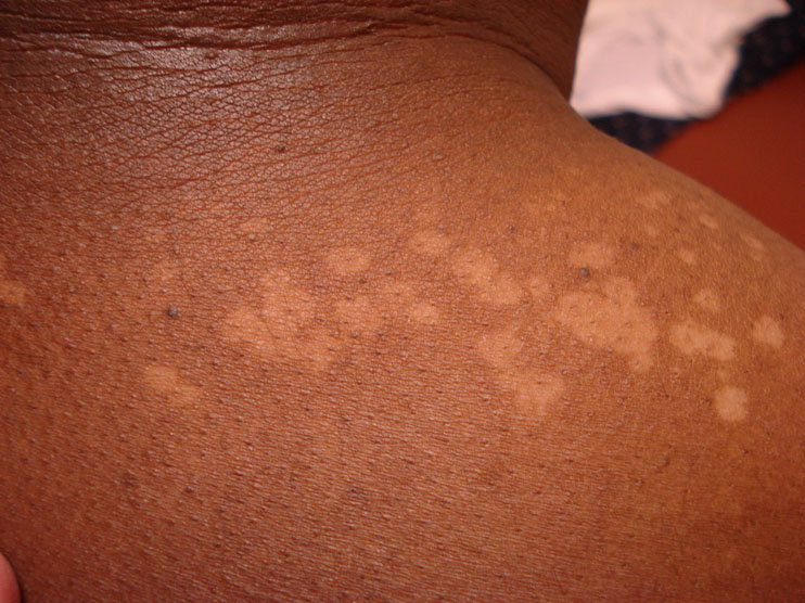 Tiny White Spots on Black Skin