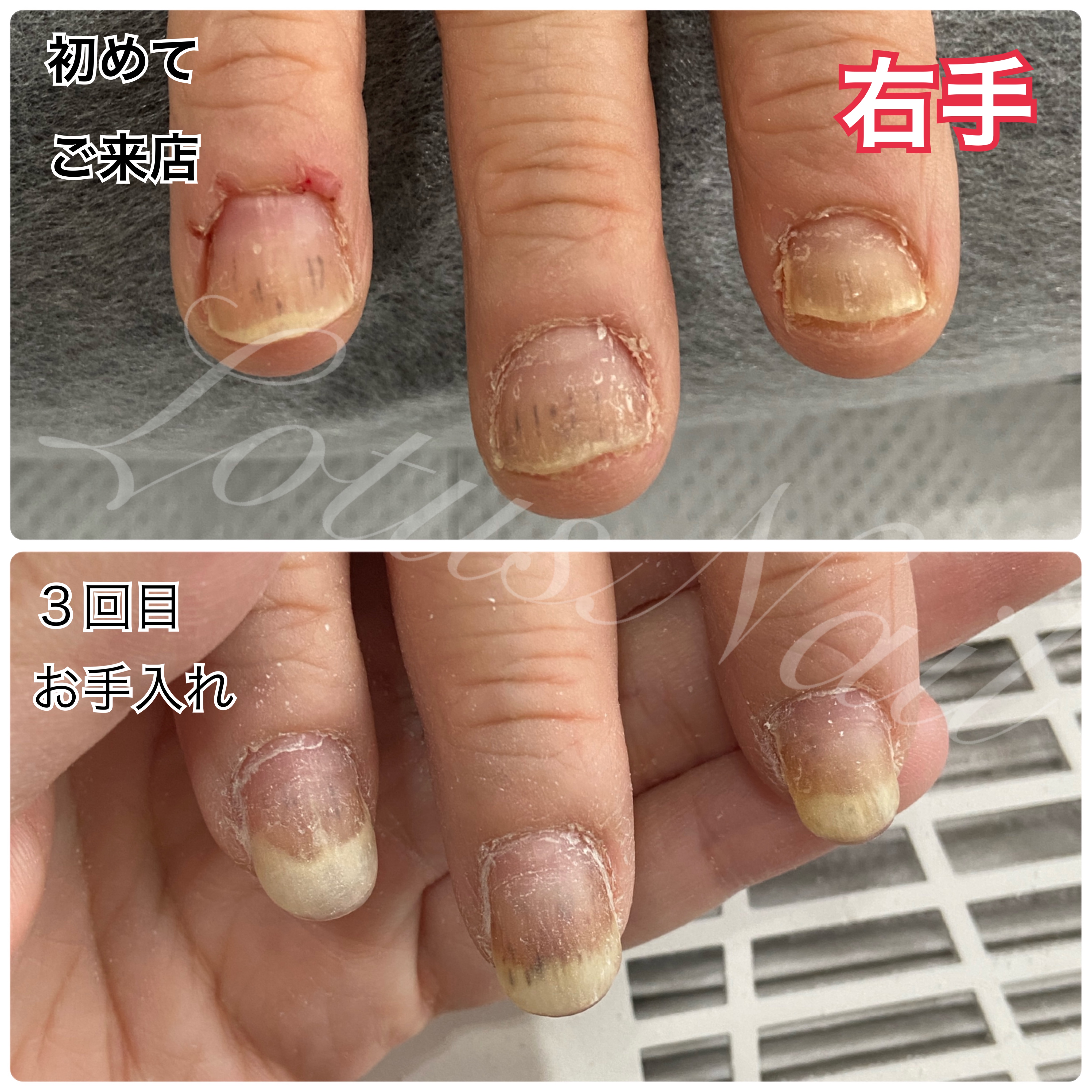 ジェルネイルアレルギー突然発症の理由と水ぶくれ対処法・最新対策