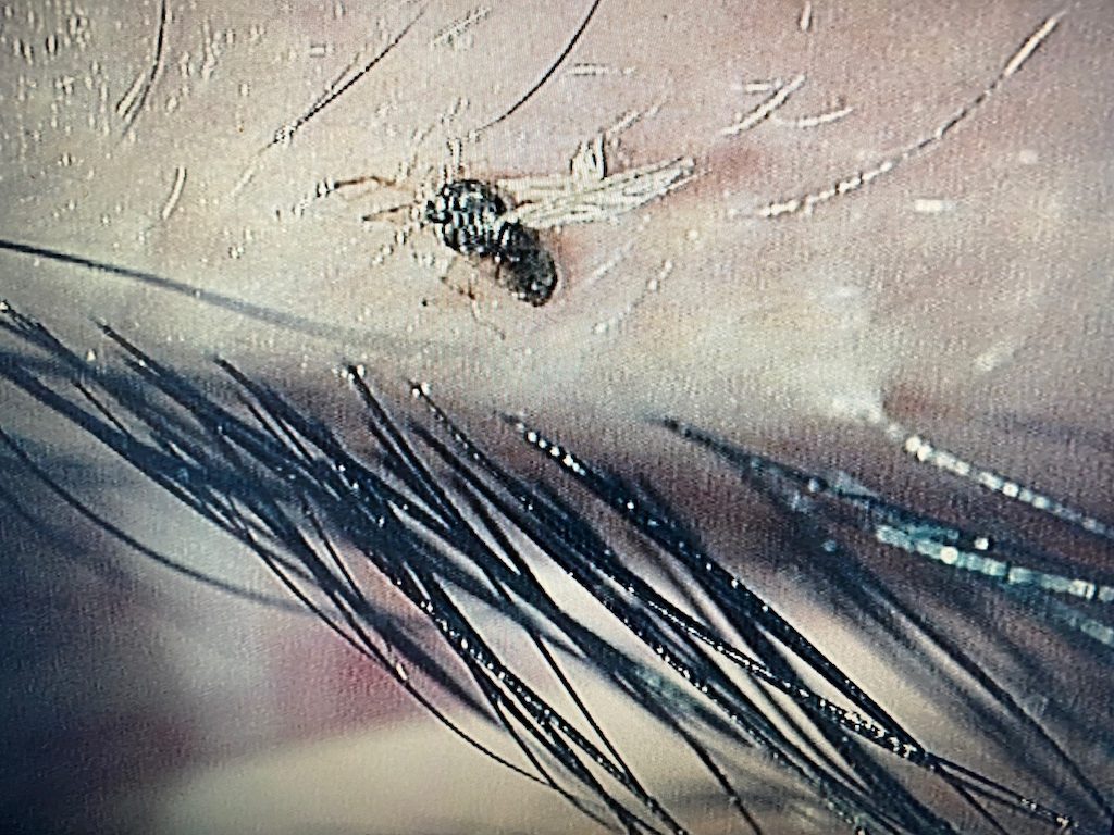 目に虫が入ったら絶対こするな！痛い取れない時の対処法と寄生虫リスク