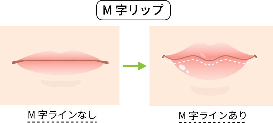 憧れのM字リップの作り方と整形の真実｜失敗リスクとメイク術を徹底比較