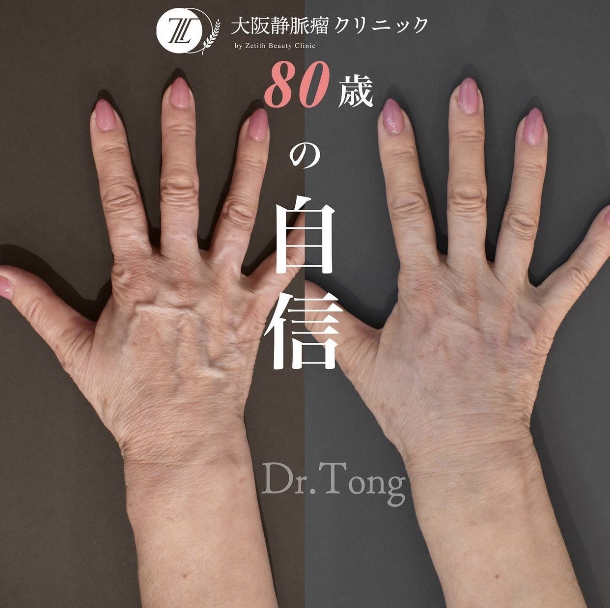 手の血管が浮き出る原因と病気のサイン｜2026年最新治療とケア