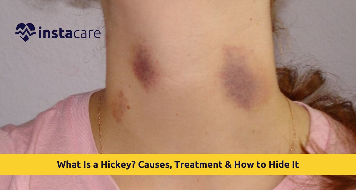 Hickies on Your Neck
