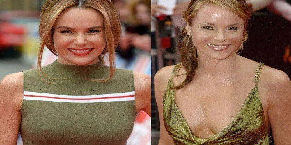 Has Amanda Holden Had a Boob Job