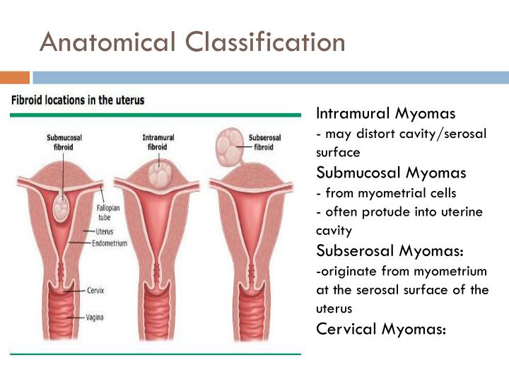 Intramural and Submucous Leiomyoma of Uterus