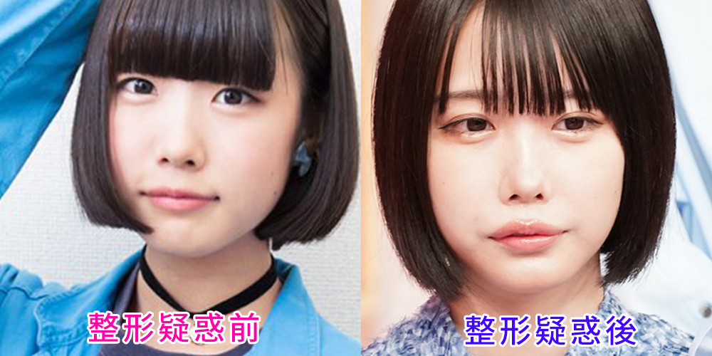 あのちゃんの顔変化を検証！整形前と噂される理由と激変の秘密