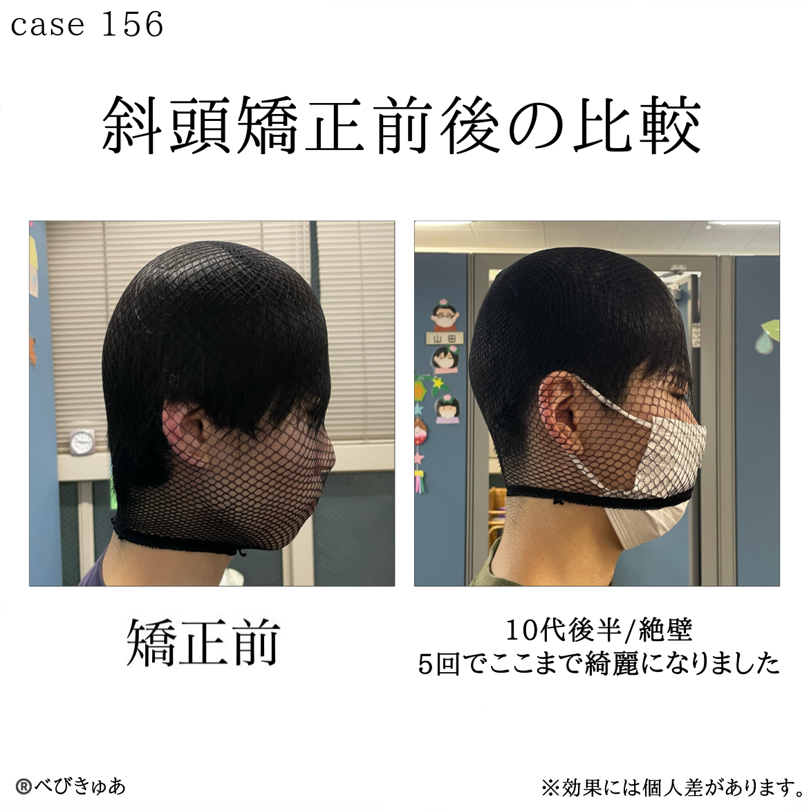 大人の絶壁頭は治る？美しい丸みを叶える改善策と噂の真相を追う