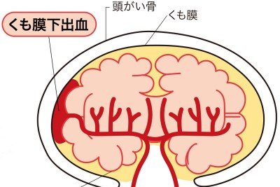 【Wiki風】 星野 源 くも膜 下 出血 衝撃の最新ニュース #668