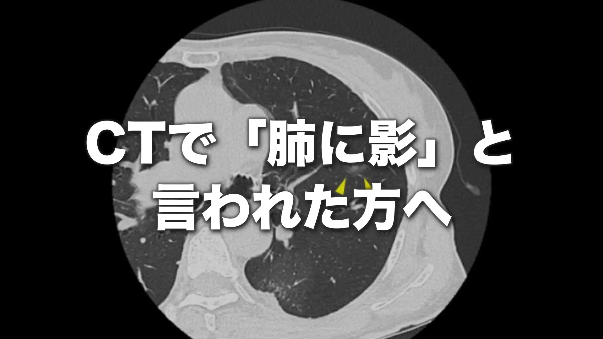 健康診断で肺に影？Ct検査でわかる病気とがんの確率を徹底解説