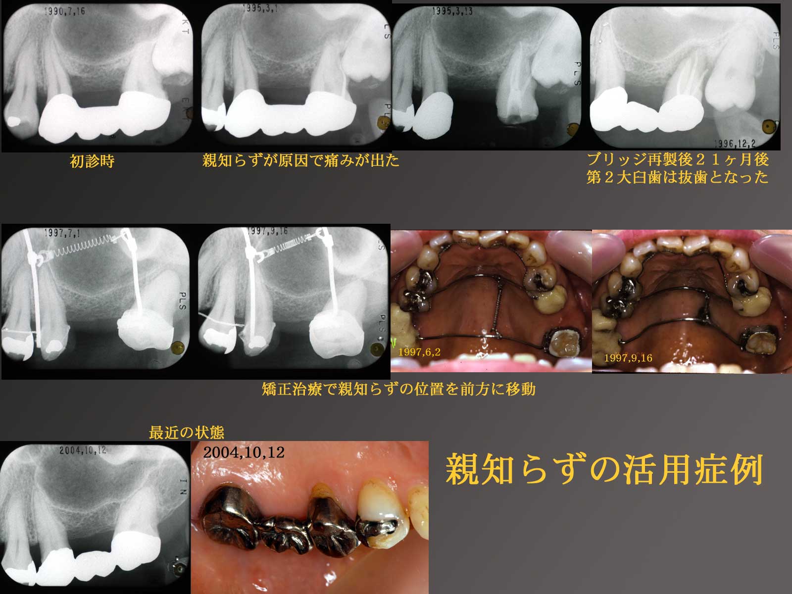 親知らず抜歯はどれほど痛い？なんＪ壮絶体験談と後悔ゼロの対処法