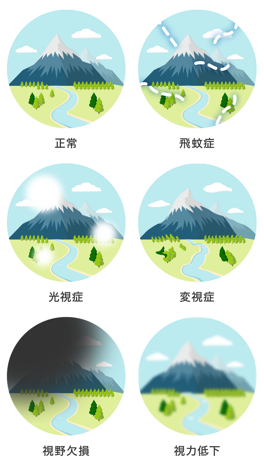 網膜剥離の見え方とは？初期症状の光や黒い影の正体と受診目安を検証