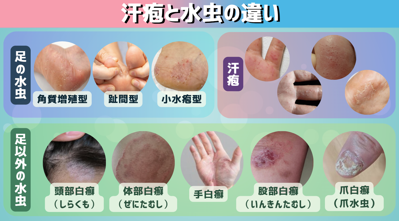 足の痒い水ぶくれは汗疱か水虫か？初期症状の見分け方と正しい対処法