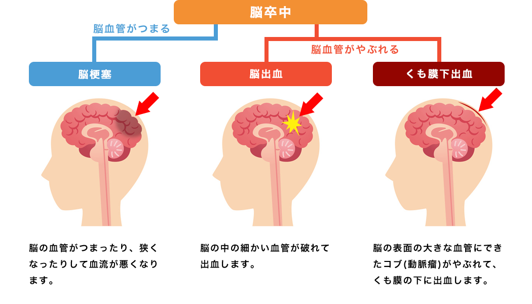 【2026年最新医療】命を救う「4.5時間の壁」：脳卒中と脳梗塞の決定的な違いと今知るべき救命サイン