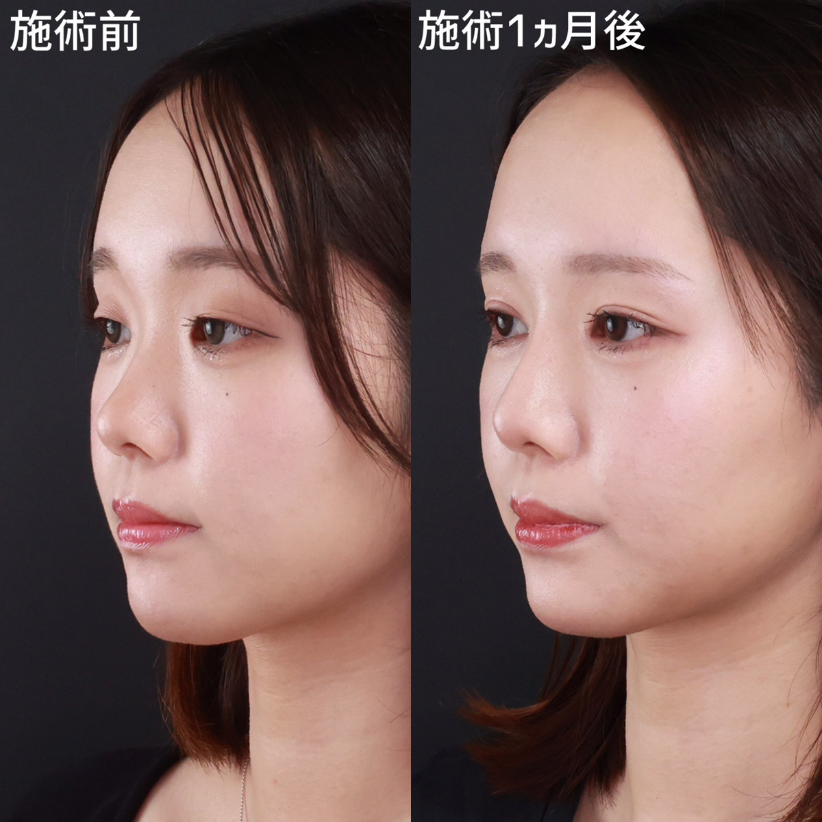 整形バレバレと噂される芸能人の真相！昔と現在の激変理由を徹底検証