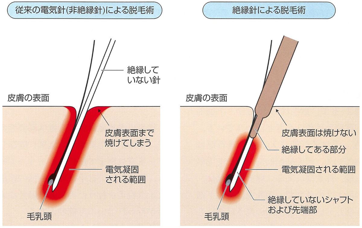 ニードル脱毛とは？激痛の真相と白髪・硬毛化を消し去る最後の砦