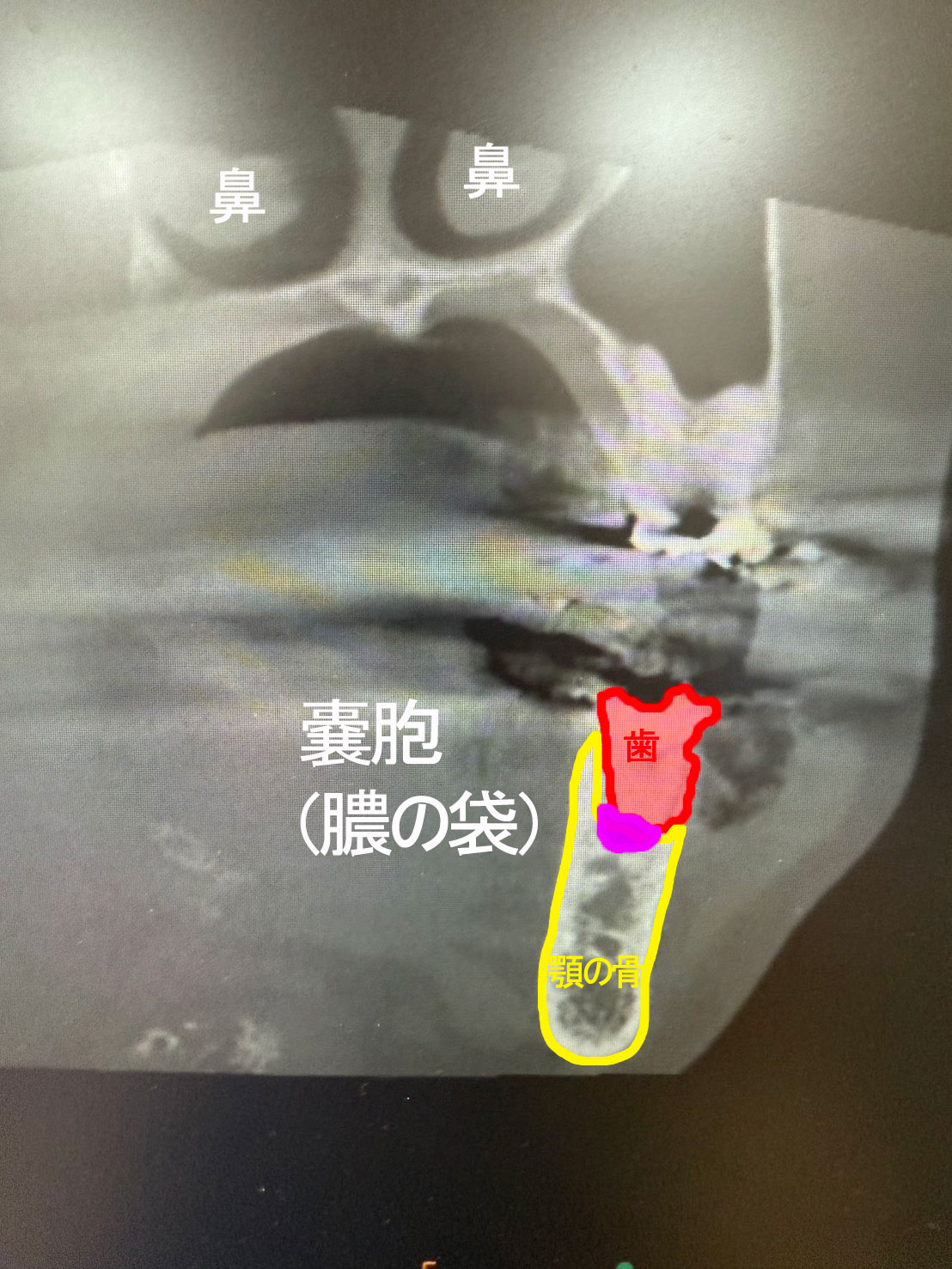 歯茎の膿の袋は自然治癒する？潰すリスクと痛くない理由の真相