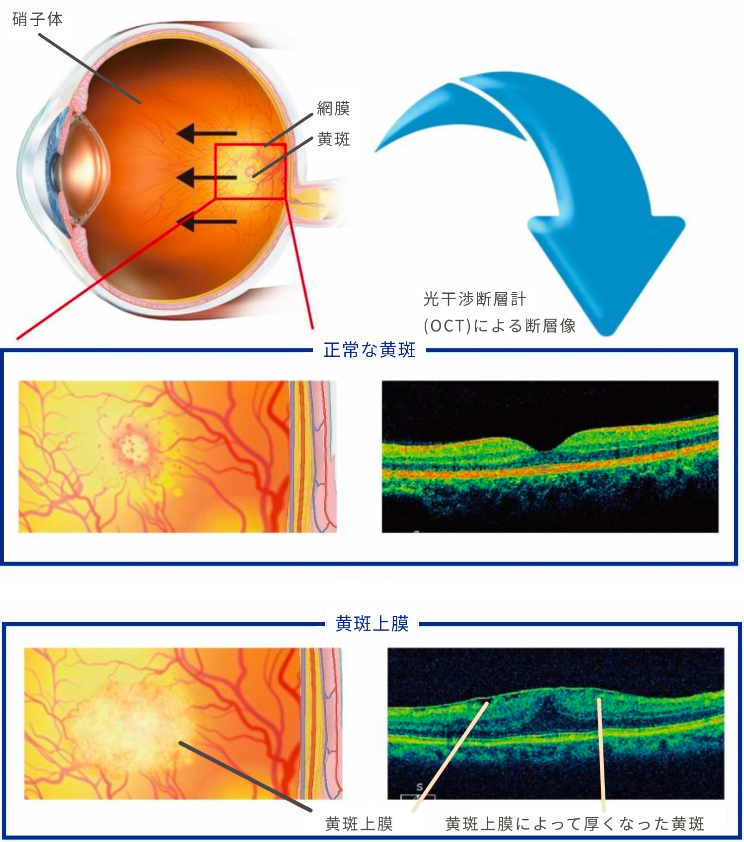 黄斑上膜で失明する？手術のタイミングと歪みの治り方を徹底解説