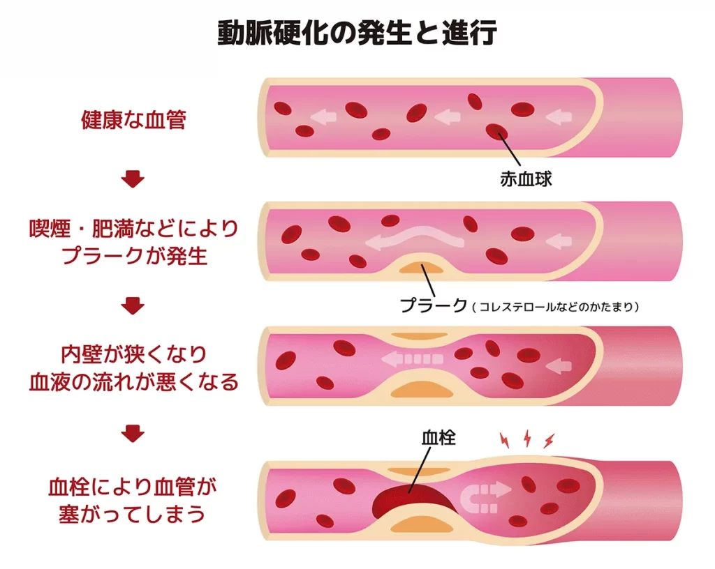 アテローム血栓性脳梗塞の前兆を見逃すな！命に関わる3つの初期症状