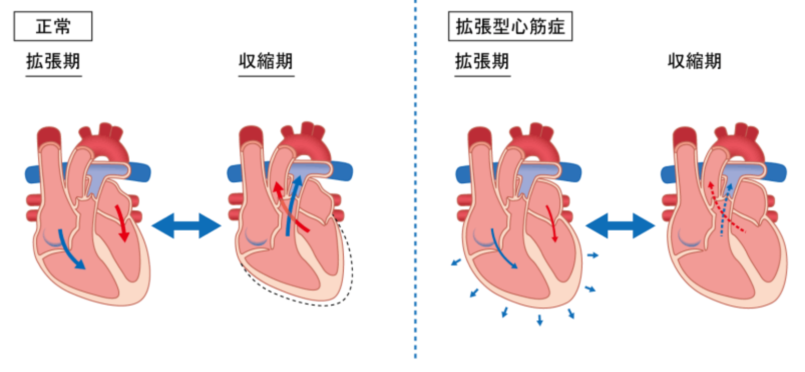 拡張型心筋症の初期症状と余命の真実｜2026年最新治療と難病指定