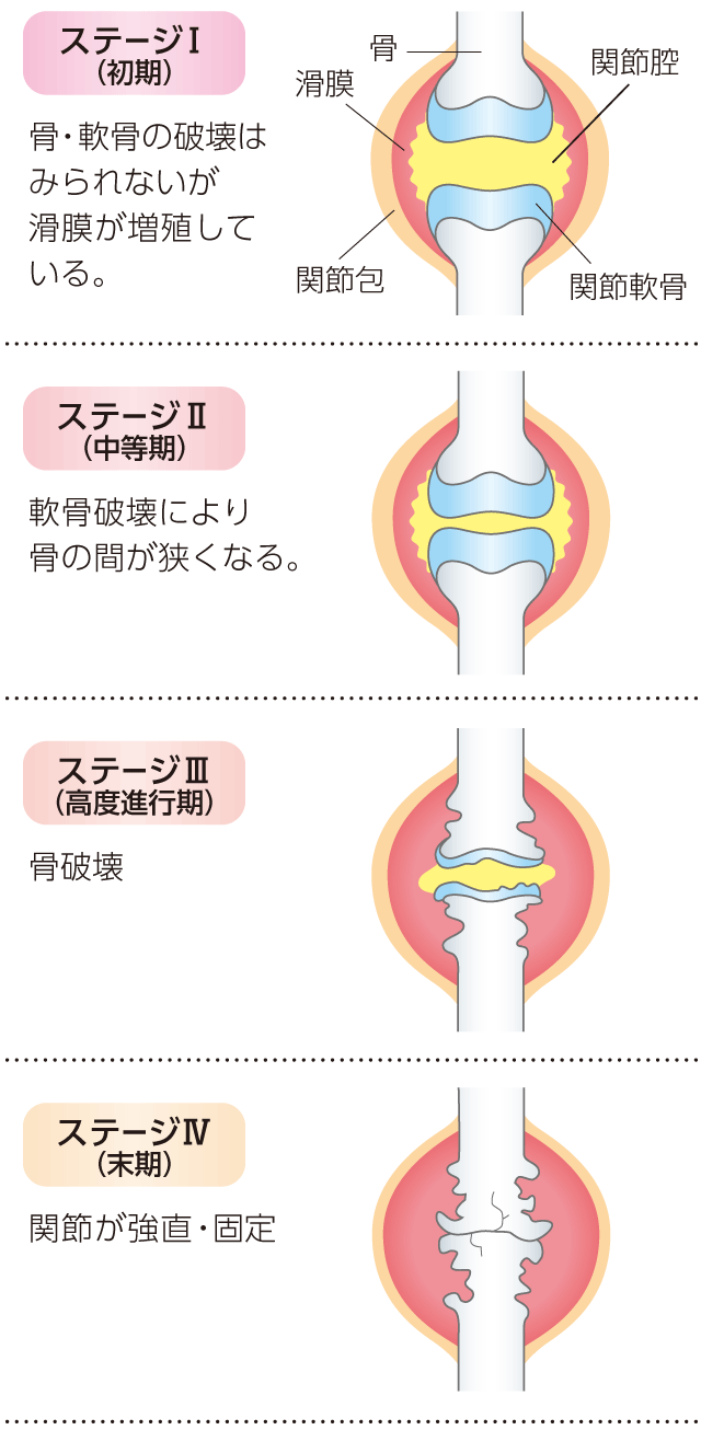 関節リウマチ初期症状のサインと見分け方！受診目安や最新治療を徹底解説