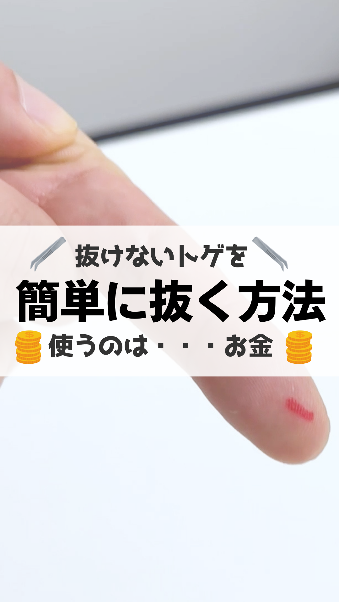 トゲが取れない時の安全な抜き方と放置の危険性｜痛まない裏ワザ解説